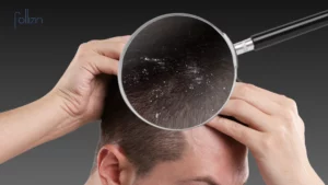 How to Get Rid of Dandruff by Washing Your Hair Correctly